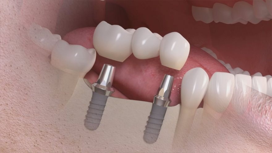 Impianti dentali - studio dentistico a Varese