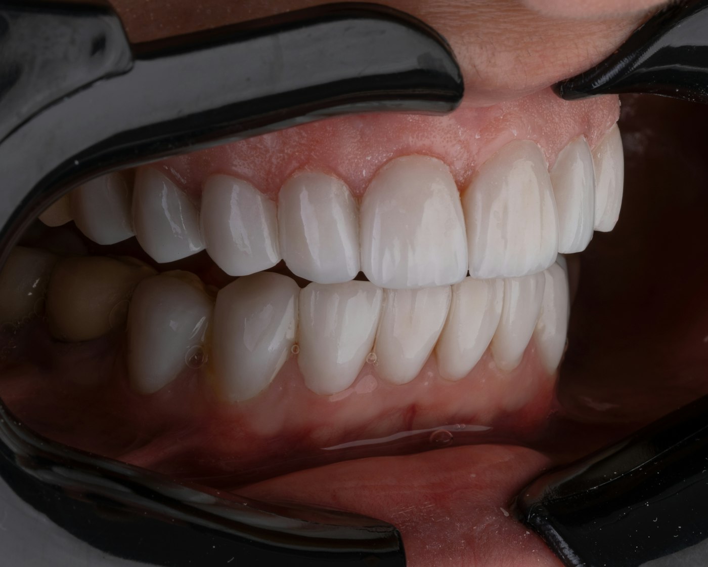 Estetica dentale a Varese - sbiancamento e faccette